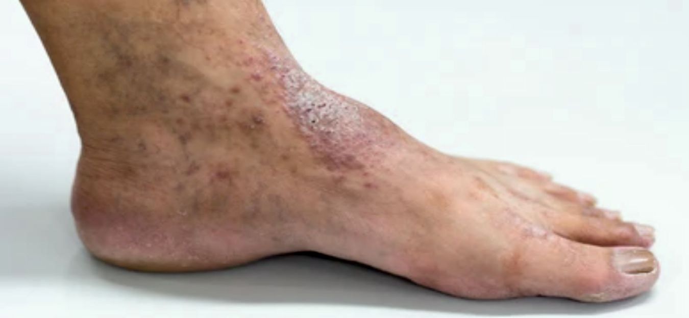 Dermatitida