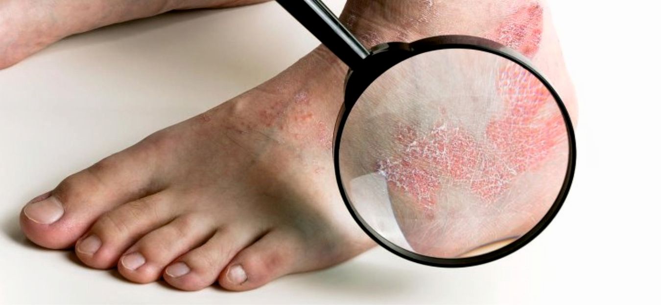 Psoriaza