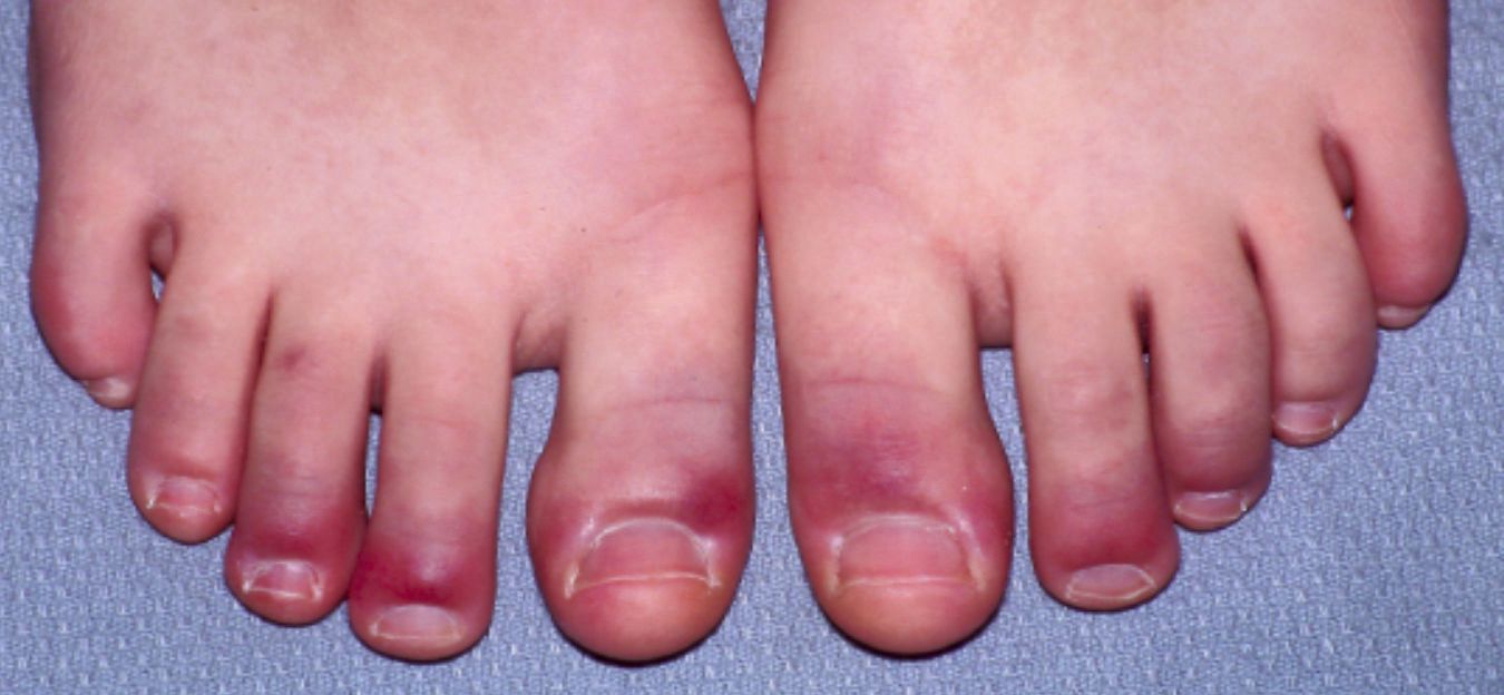 Raynaudov-syndrom
